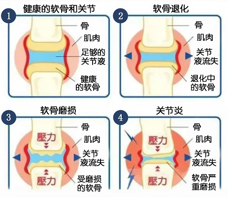 關(guān)節(jié)變化過程