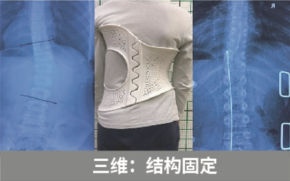 直樂六維脊柱側(cè)彎矯形——結(jié)構(gòu)固定