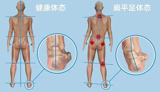 扁平足體態(tài)和健康體態(tài)對(duì)比圖