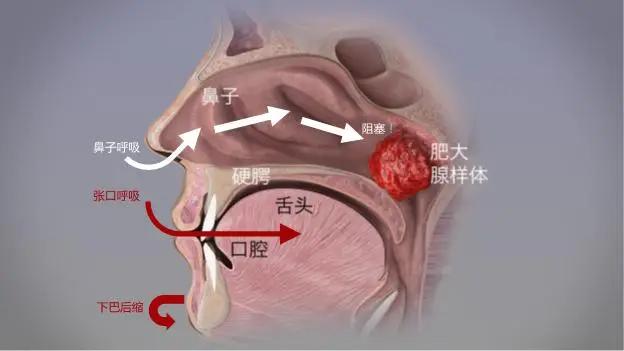 腺樣體肥大堵塞鼻腔呼吸通道
